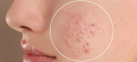 Brote de acné en la cara. ¿Cómo solucionarlo?