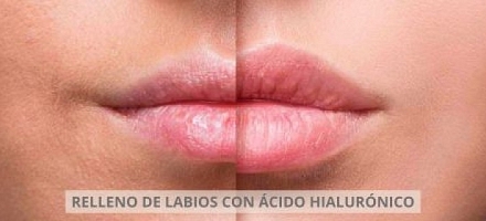 Como hidratar los labios después de ácido hialurónico