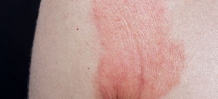 Piel rosada después de una costra
