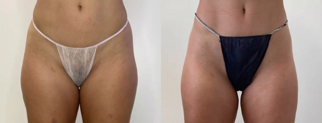 Resultados tratamiento bodyshock mesoestetic