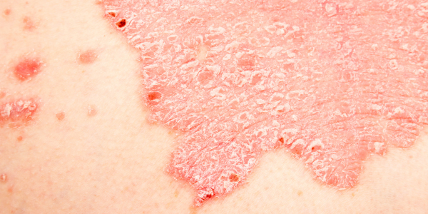 Placa de psoriasis con enrojecimiento y descamaci&oacute;n visible en la piel