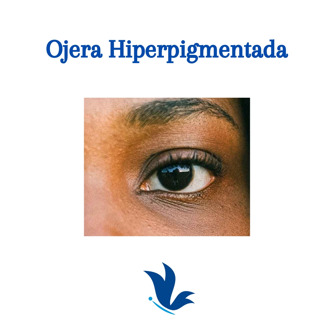 Ojera Hiperpigmentaci&oacute;n