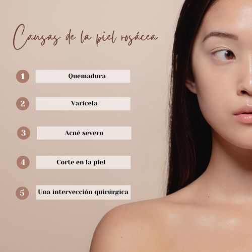 Infografía causas de la piel con rosácea: quemaduras, cirugias, acne y heridas