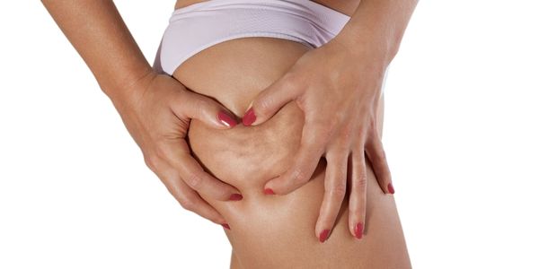 Mujer pellizcando el muslo para mostrar la piel de naranja